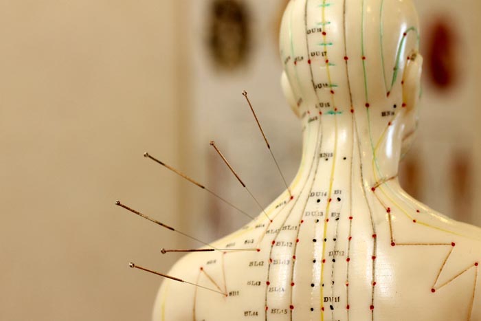 Akupunktur als Alternativmedizin